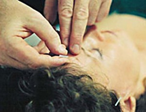 Acupuncture Treatment in Ontario with Aromatica