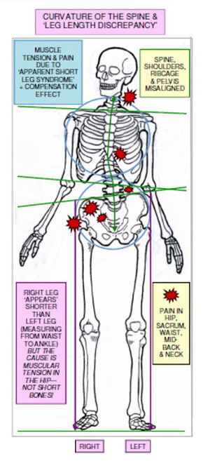 Contraction Release Therapy, CRT for Scoliosis