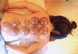 Traditional Chinese Fire Cupping