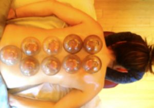 Learn Traditional Chinese Fire Cupping